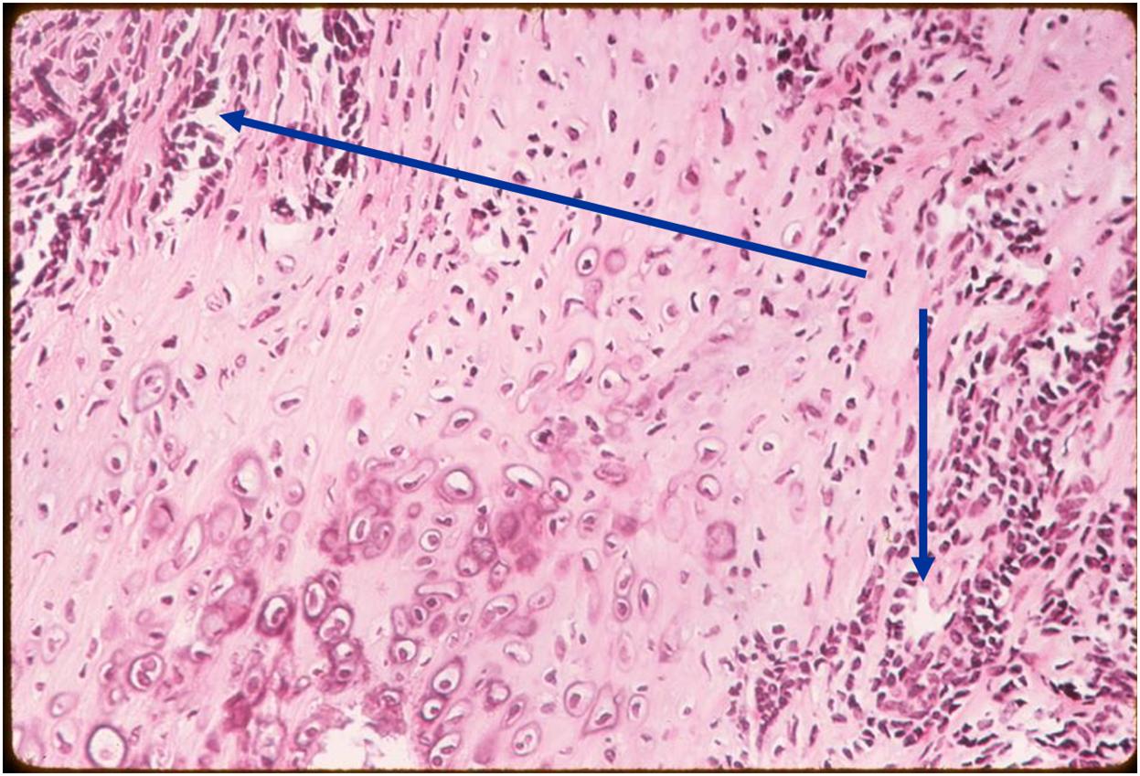 Cartilage Component<br />(Arrows) Mesenchymal Component