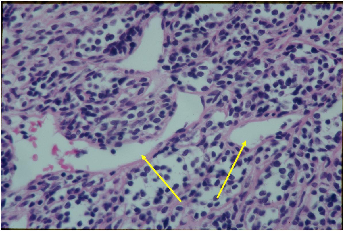 Large Staghorn Blood Vessels