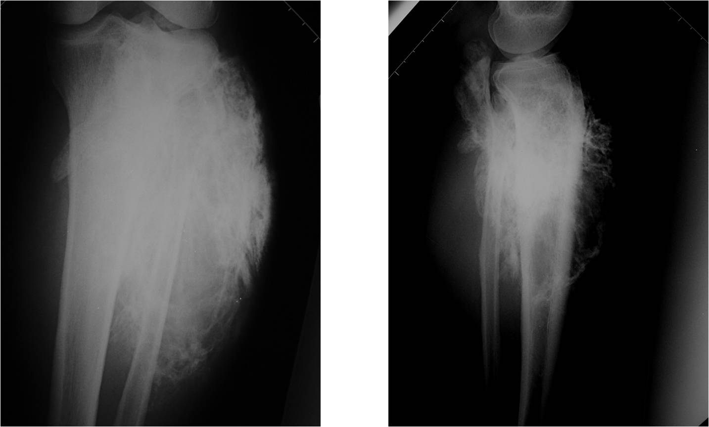 X-RAY: Large Osteosarcoma of Proximal Tibia. Large ossified soft tissue component X-RAY: Large Osteosarcoma of Proximal Tibia. Large ossified soft tissue component