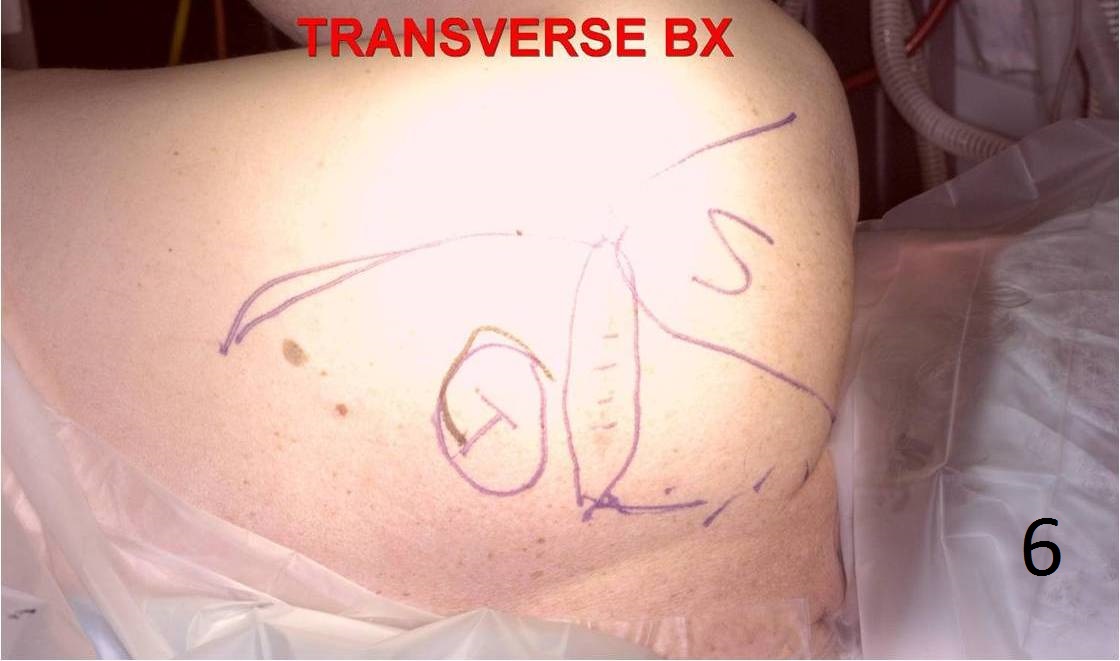 Fig. 6 Intraoperative photograph of skin incisions to remove a pleomorphic liposarcoma from the trapezius area. The patient had a previous biopsy through a transverse incision. Transverse incisions should rarely be used to biopsy a tumor. Fig. 6 Intraoperative photograph of skin incisions to remove a pleomorphic liposarcoma from the trapezius area. The patient had a previous biopsy through a transverse incision. Transverse incisions should rarely be used to biopsy a tumor.