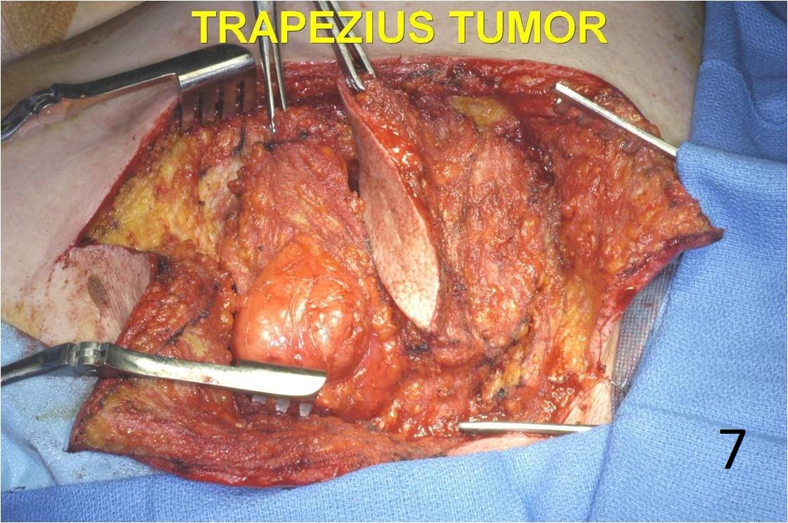 Fig. 7 Photograph shows the tumor and the biopsy tract. Fig. 7 Photograph shows the tumor and the biopsy tract.