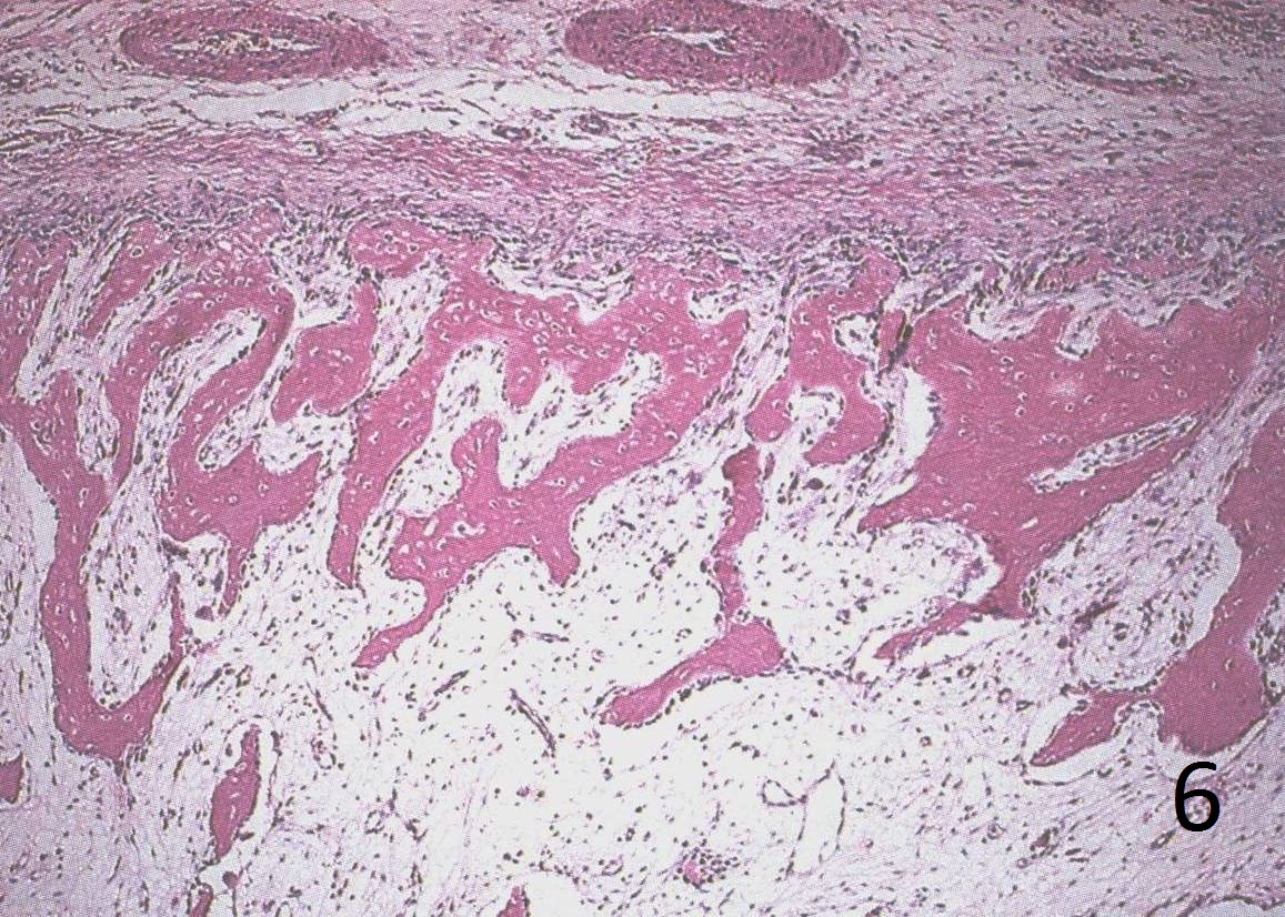 Fig. 6: Low power magnification demonstrates mature bone and fibroblastic cells.