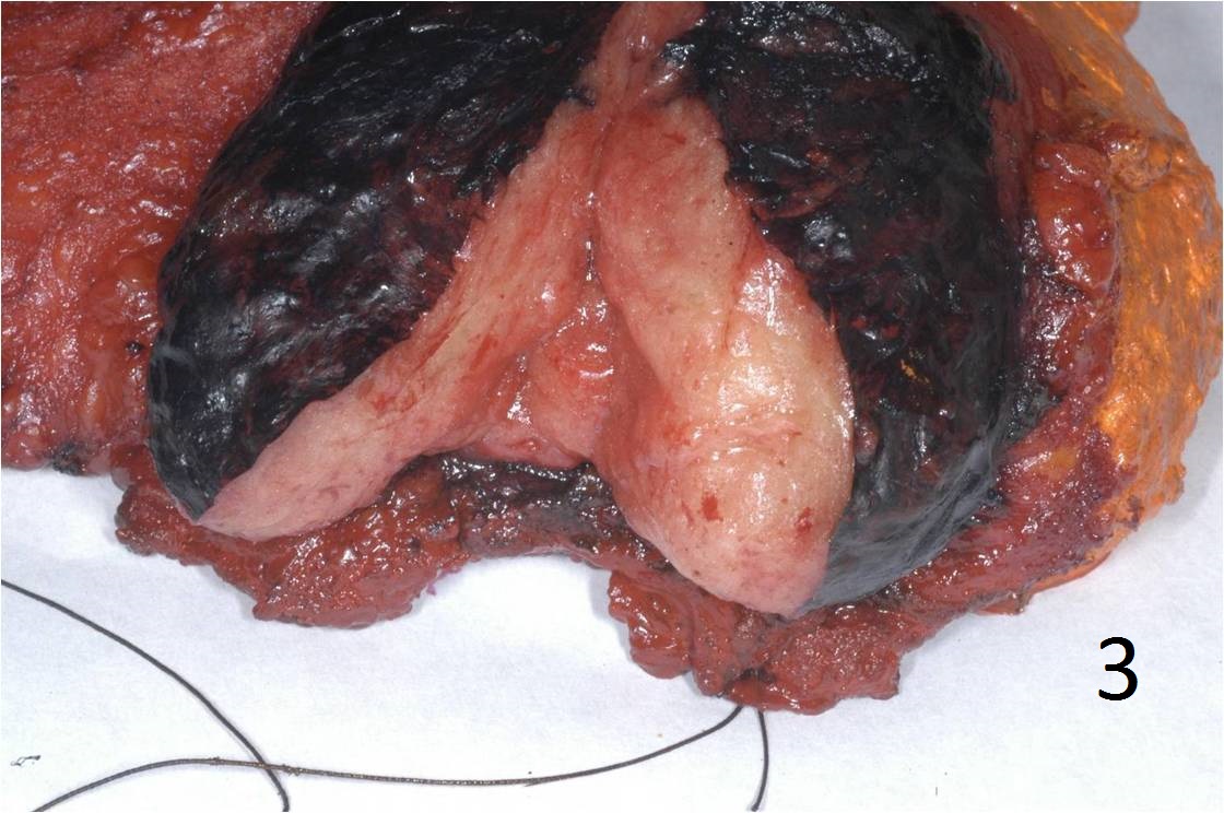 Fig. 3 Gross Pathology: Photo of a gross specimen. Fig. 3 Gross Pathology: Photo of a gross specimen.