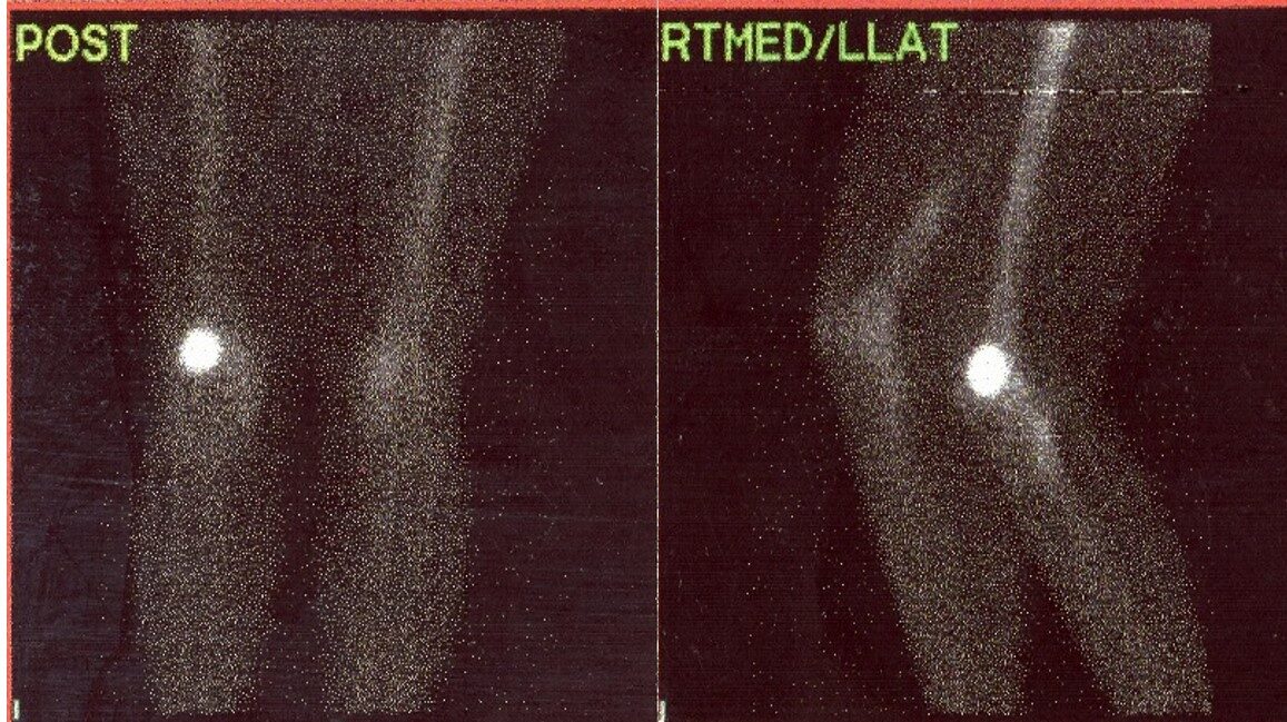 Fig. 8: Bone scintigraphy. Anterior and lateral bone demonstrates increased radiotracer uptake in the left lateral supracondylar femur.