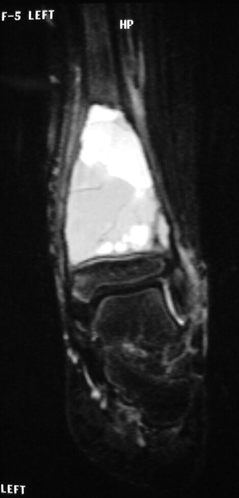 Fig 2 a: Coronal T2 weighted MRI of an ABC Fig 2 a: Coronal T2 weighted MRI of an ABC