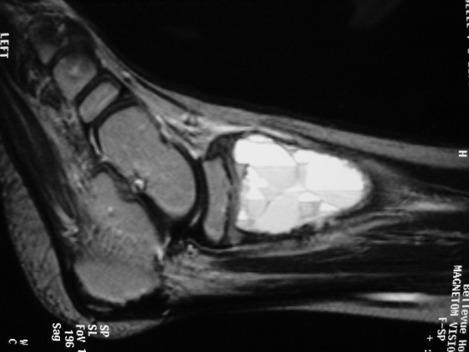 Fig 2b: Sagittal T2 weighted MRI of and ABC Fig 2b: Sagittal T2 weighted MRI of and ABC