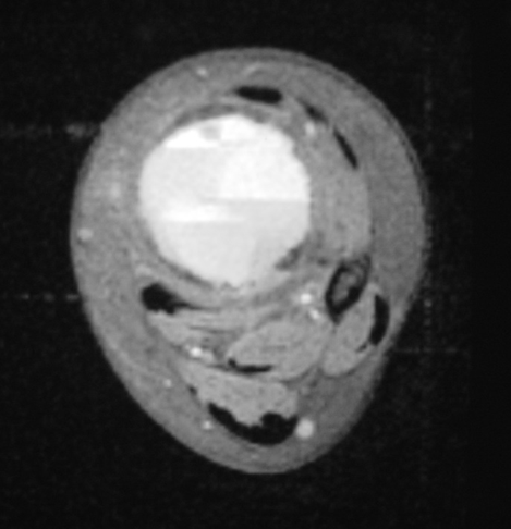 Fig 2c: Axial T2 weighted MRI of an ABC Fig 2c: Axial T2 weighted MRI of an ABC