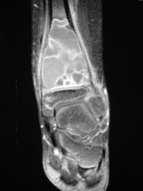 Fig 2d: Coronal gadolinium enhanced MRI of an ABC Fig 2d: Coronal gadolinium enhanced MRI of an ABC