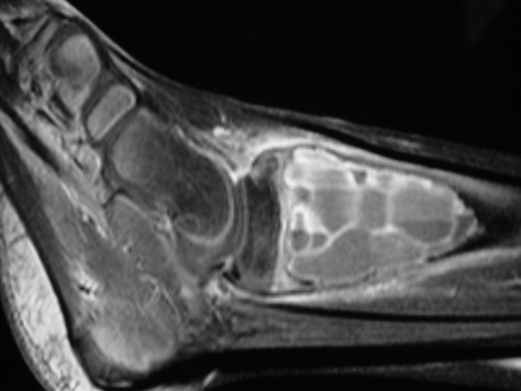 Fig 2e: Sagittal gadolinium enhanced MRI of an ABC Fig 2e: Sagittal gadolinium enhanced MRI of an ABC