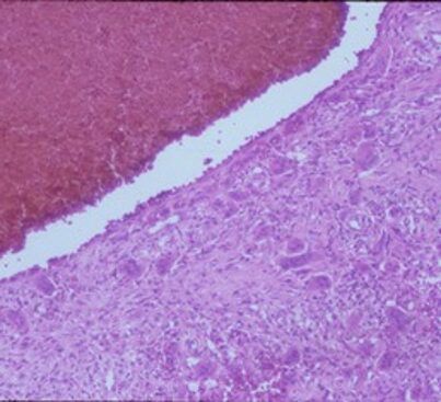 Figure 3a: There is a large blood filled cystic cavity surrounded by a fibrous septae that includes benign appearing spindle cells, fibrous extracellular matrix and scattered giant cells. There are areas of reactive bone formation. The fibroblastic cells are bland appearing. There are no abnormal mitotic figures. Figure 3a: There is a large blood filled cystic cavity surrounded by a fibrous septae that includes benign appearing spindle cells, fibrous extracellular matrix and scattered giant cells. There are areas of reactive bone formation. The fibroblastic cells are bland appearing. There are no abnormal mitotic figures.