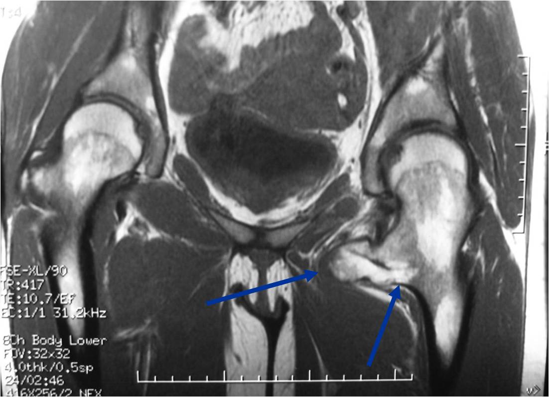 MRI: Left proximal Femur Osteochondroma Cortical Medullary Continuity and Thin Cartilage Cap MRI: Left proximal Femur Osteochondroma Cortical Medullary Continuity and Thin Cartilage Cap