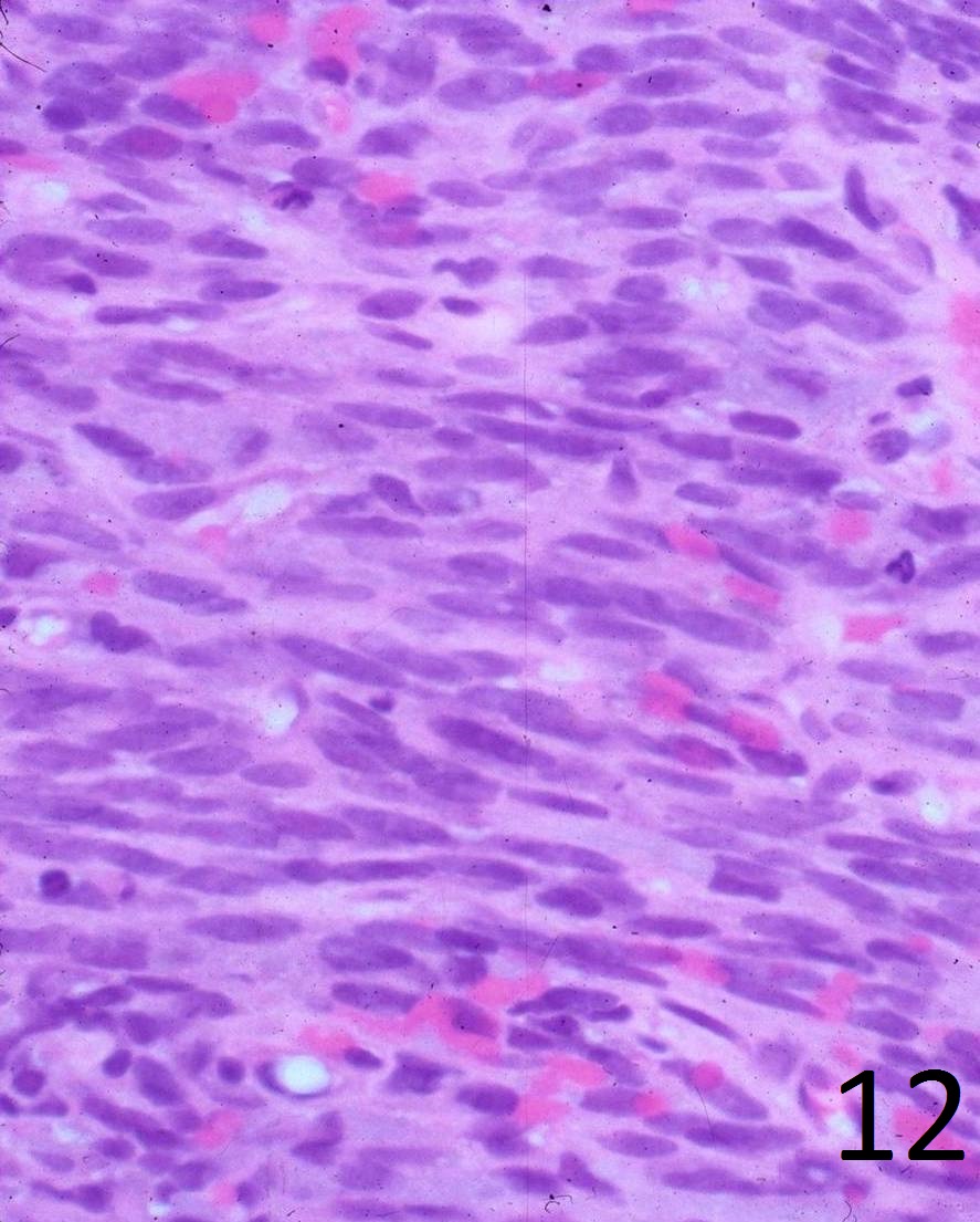 Fig. 12: High power magnification shows elongated spindle cells (cigar shaped cells) with large nuclei, scant cytoplasm and frank pleomorphism. There are abnormal mitoses and there is a fibrous tissue matrix interspersed between the cells. The cells are producing fibrous tissue.