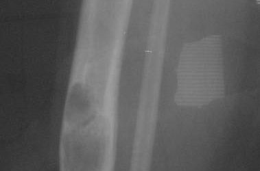 Adamantinoma: A Rare Bone Tumor of the Tibia Explained