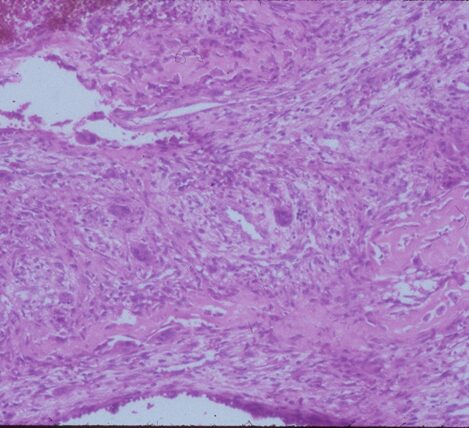 Fig 3b: Intermediate power of a septum of an ABC: There is no epithelial lining around the wall of the cavity filled with blood. There are spindle cells and scattered giant cells.