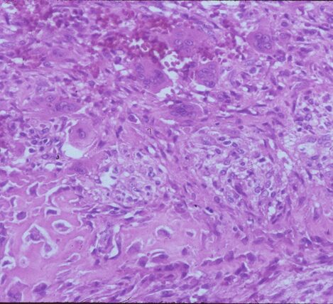 Fig 3c: High power view of an ABC: Demonstrates reactive bone formation within the wall of the cystic cavities. This is reactive bone and different from the lace like immature bone layed down by an osteosarcoma