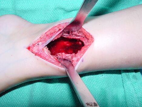 Fig 4. Intraoperative photograph showing a curettage of an ABC of the distal tibia through a medial approach. The tumor is usually curetted and then the cavity is shaved down with a midas rex burr. This is called a resectional curettage and reduces the risk of local recurrence. Additional adjuvants such as liquid nitrogen may be used to treat the cavity and irradicate microscopic tumor cells. The cavity is usually filled with bone graft or bone cement. Fixation devices may be used in specific situations to prevent postoperative fracture. 
