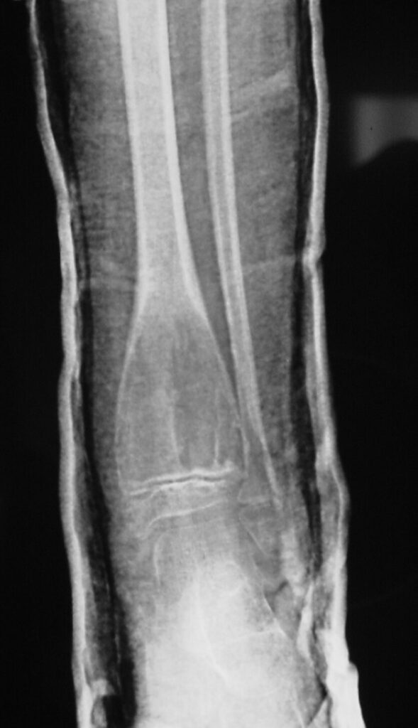 Fig 1a. Plain X-ray (AP View).  ABC of the Distal Tibia: Geographic Well Circumscribed Lesion in the distal tibia. The cortices are expanded. There are internal septations. There is no internal mineralization. There is no evidence of a malignant appearing periosteal reaction such as a sunburst or hair on end pattern or codman’s triangle.