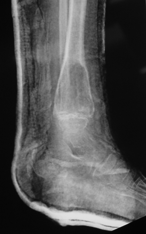 Fig 1b: Plain X-ray (Lateral View): ABC of Distal Tibia. Notice how the cortices or bony contour appears expanded. The tumor has been eroding the inner aspect of the cortex of the bone. In response the periosteum on the outside lays down new bone which gives the bone and expanded contour.