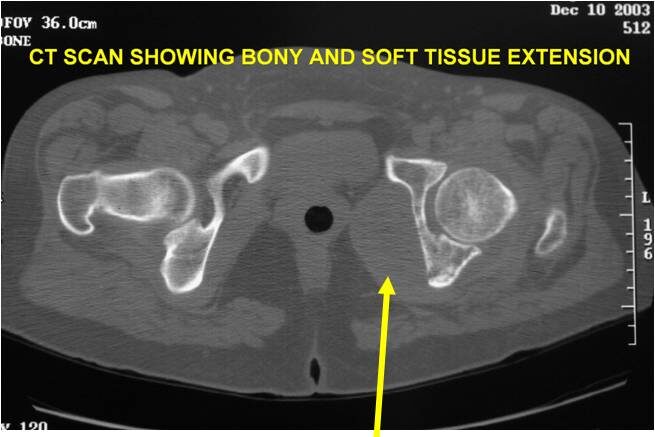 CT and MRI: Dedifferentiated Chondrosarcoma of Left Acetabulum
