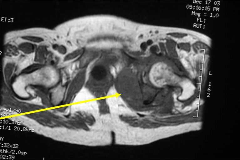 MRI: Dedifferentiated Chondrosarcoma of Left Acetabulum