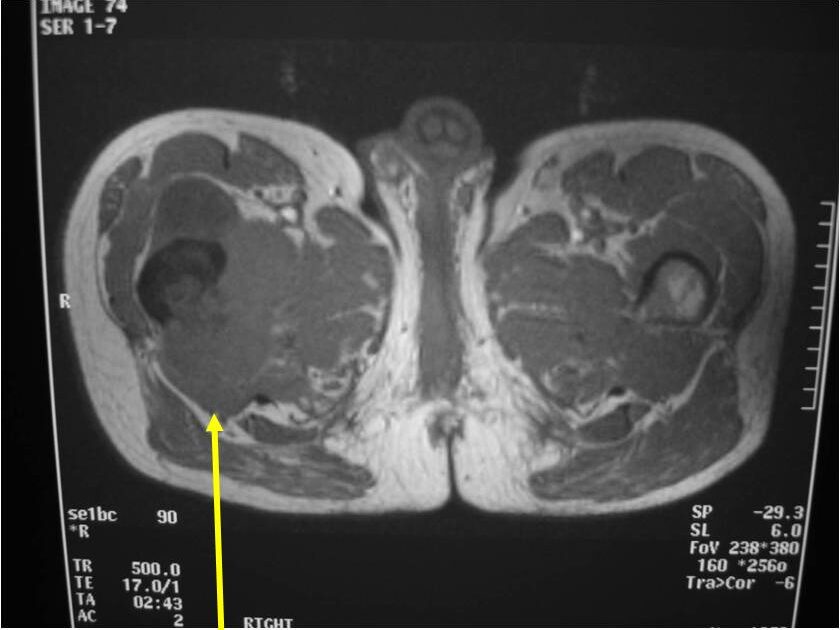 MRI: Dedifferentiated Chondrosarcoma of Proximal Femur TI Weighted Image Cortical Destruction and Soft Tissue Extension