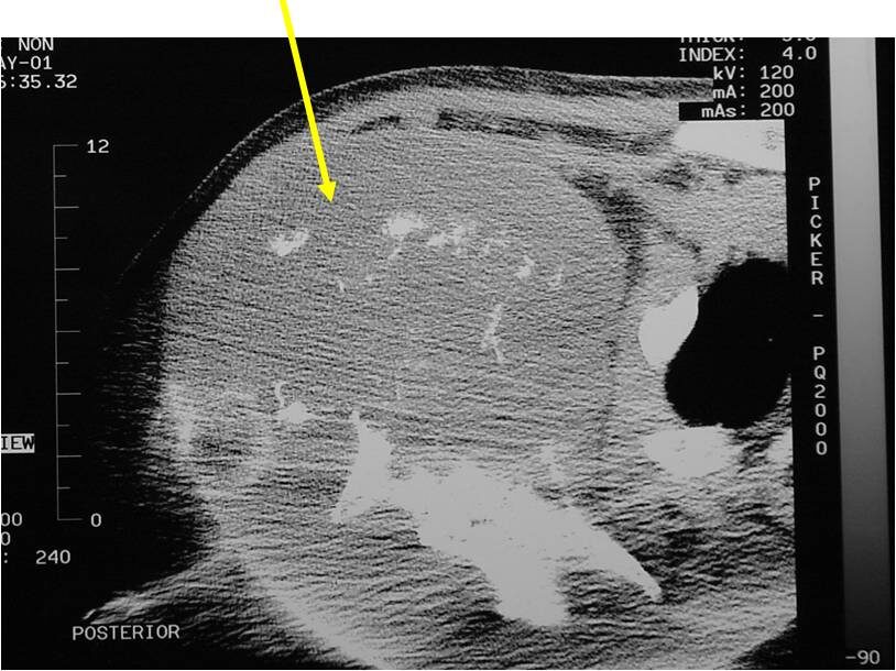 X-ray and CT Scan: Dedifferentiated Chondrosarcoma of Scapula Large Soft Tissue Mass from Scapula Calcifications