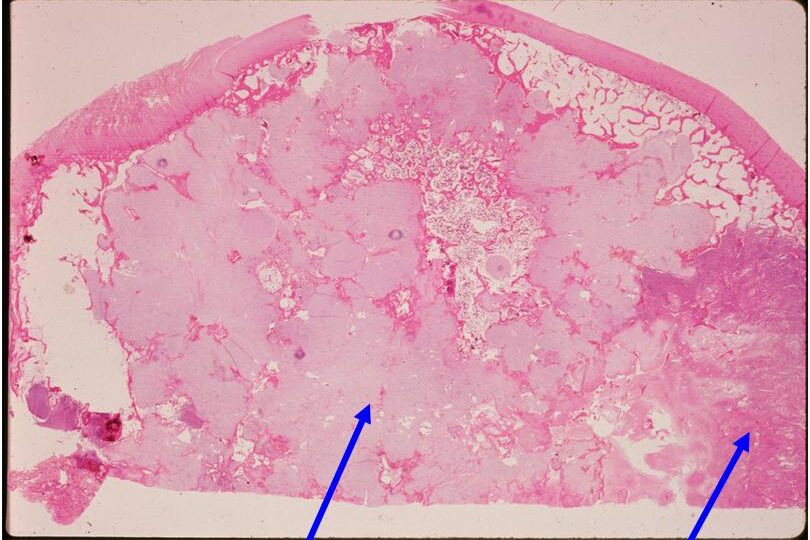 Dedifferentiaed Chondrosarcoma of Distal Humerus (Left Arrow)Low Grade Cartilage Componenet (Right Arrow) & Dedifferentiated Component