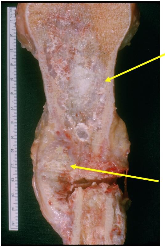 Dedifferentiaed Chondrosarcoma of Humerus (Top Arrow) Low Grade Cartilage (Bottom Arrow) High Grade Dedifferentiated Specimen Component