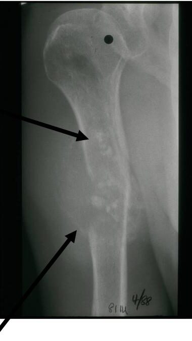 Low Grade Cartilage Component Stippled Calcifications Aggressive Dedifferentiated Sarcomatour Component Lysis, Cortical Destruction Soft Tissue Mass without Calcification