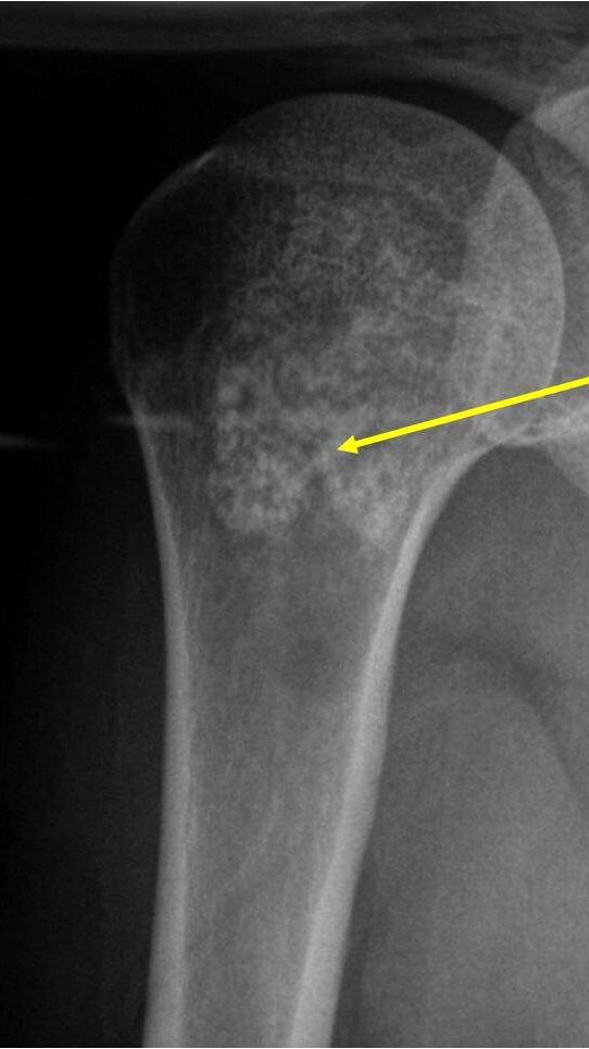 Plain X-Ray: Enchondroma of Proximal Humerus Metaphyseal Tumor Heavy Calcifications Ring and Arc Pattern of Calcifications Minimal Endosteal Scalloping No Cortical Destruction No Periosteal Reaction No Cortical Destruction No Soft Tissue Component Plain X-Ray: Enchondroma of Proximal Humerus
Metaphyseal Tumor Heavy Calcifications Ring and Arc Pattern of Calcifications Minimal Endosteal Scalloping No Cortical Destruction No Periosteal Reaction No Cortical Destruction No Soft Tissue Component