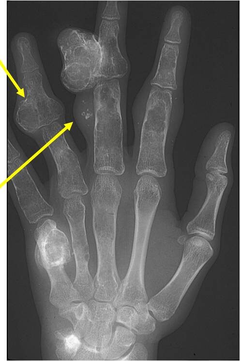 Plain X-Ray of Hand: Maffucci Syndrome (Top Arrow) Enchondromas (Bottom Arrow) Phleboliths Plain X-Ray of Hand: Maffucci Syndrome (Top Arrow) Enchondromas (Bottom Arrow) Phleboliths