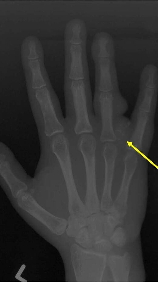 Plain X-Ray of Hand: Maffucci Syndrome Plain X-Ray of Hand: Maffucci Syndrome