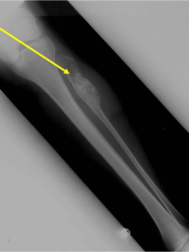 Plain X-rays: Enchondromatosis Maffucci's Syndrome Plain X-rays: Enchondromatosis Maffucci's Syndrome
