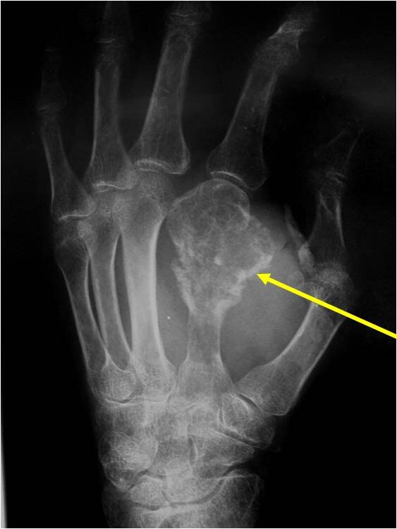Example of Chondrosarcoma of Metacarpal of Hand There is cortical destruction and a soft tissue mass Enchondromas do not extend into the soft tissues Example of Chondrosarcoma of Metacarpal of Hand There is cortical destruction and a soft tissue mass Enchondromas do not extend into the soft tissues