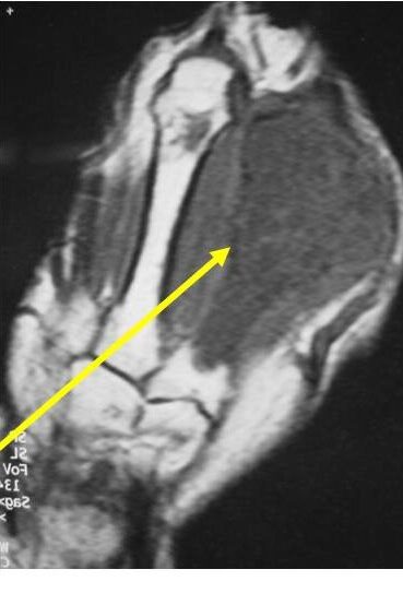 Example of Chondrosarcoma of Metacarpal of Hand There is cortical destruction and a soft tissue mass Enchondromas do not extend into the soft tissues Example of Chondrosarcoma of Metacarpal of Hand There is cortical destruction and a soft tissue mass Enchondromas do not extend into the soft tissues