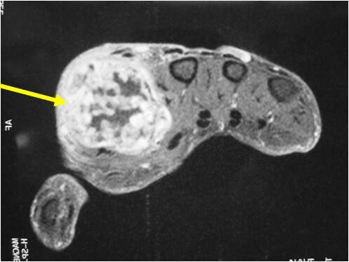 Example of Chondrosarcoma of Metacarpal of Hand There is cortical destruction and a soft tissue mass Enchondromas do not extend into the soft tissues Example of Chondrosarcoma of Metacarpal of Hand There is cortical destruction and a soft tissue mass Enchondromas do not extend into the soft tissues