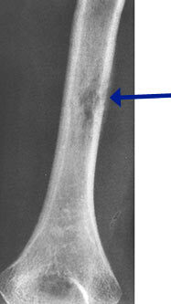 Plain X-ray: Eosinophilic Granuloma of Humerus Permeative Lesion Plain X-ray: Eosinophilic Granuloma of Humerus Permeative Lesion