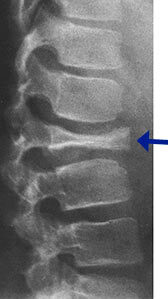 X-ray: Eosinophilic Granuloma of Spine Vertebra Plana X-ray: Eosinophilic Granuloma of Spine Vertebra Plana