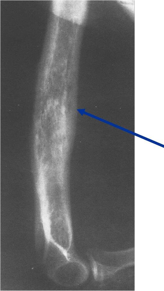 X-ray: Primary Lymphoma of Distal Humerus Permeative Lesion X-ray: Primary Lymphoma of Distal Humerus
Permeative Lesion
