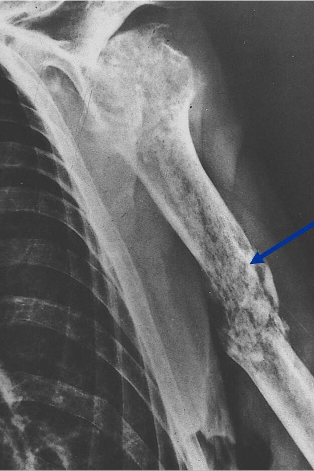 X-ray: Primary Lymphoma of Humerus Permeative/Motheaten Lesion with Pathologic Fracture X-ray: Primary Lymphoma of Humerus
Permeative/Motheaten Lesion with Pathologic Fracture