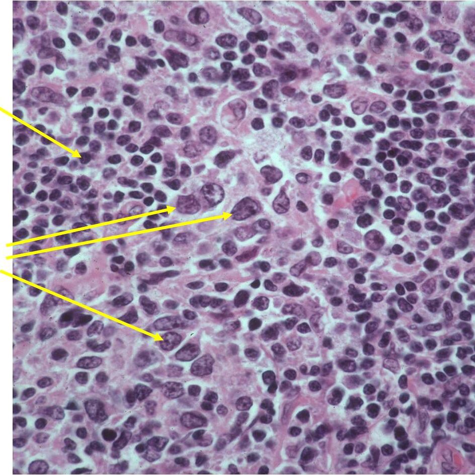 Microscopic Pathology: Lymphoma, Reactive Inflammatory, Infiltrate of Plasma Cells and Lymphocytes, Large Malignant B-cells Microscopic Pathology: Lymphoma, Reactive Inflammatory, Infiltrate of Plasma Cells and Lymphocytes, Large Malignant B-cells