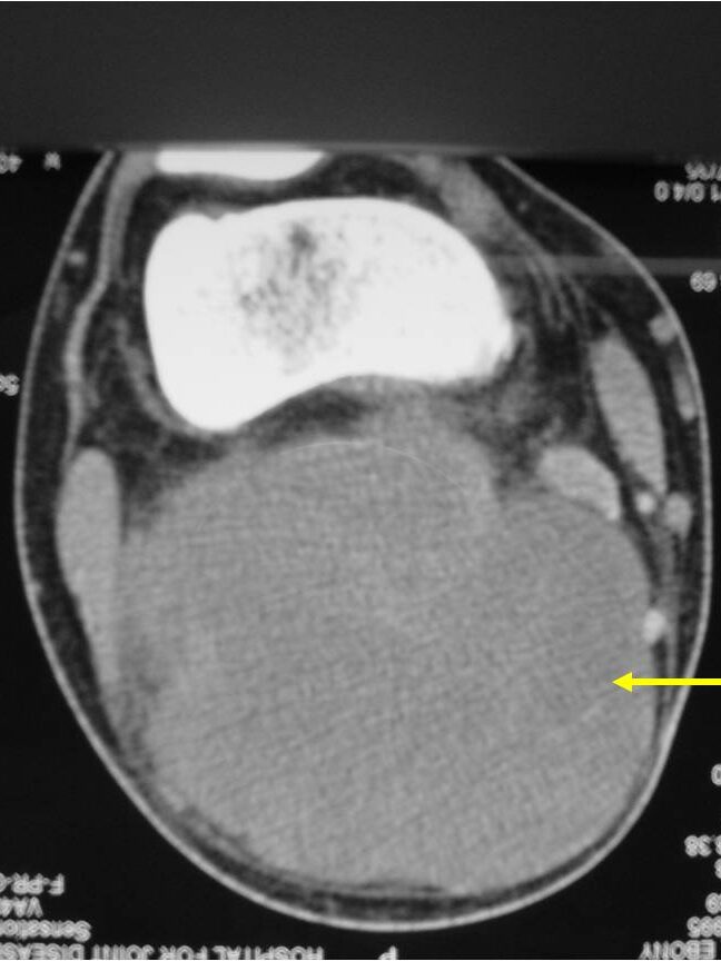 CT Scan: Extraskeletal Mesenchymal Chondrosarcoma of Popliteal Fossa No Mineralization Detected