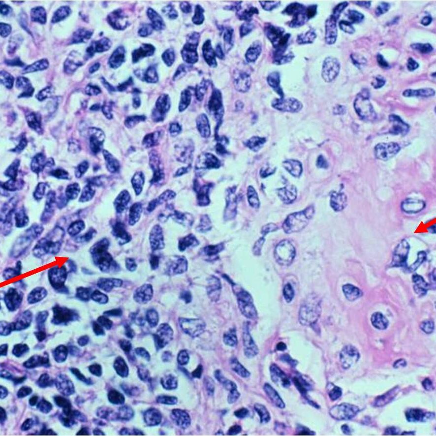 (Left Arrow) Mesenchymal Small Round Blue Cell Component
(Right Arrow) Cartilaginous Component