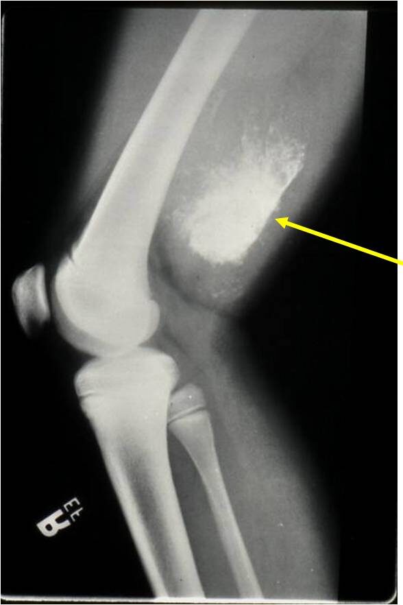Plain Radiograph of an Extraskeletal Mesenchymal Chondrosarcoma