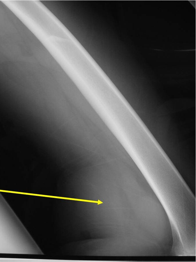 Plain X-ray: Extraskeletal Mesenchymal Chondrosarcoma of Popliteal Fossa